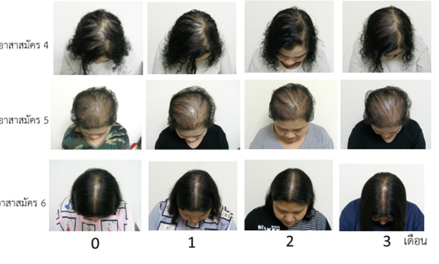 Chula Develops a Proven Formula to Combat Hair Loss and Baldness from  Mangrove Trees – Chulalongkorn University
