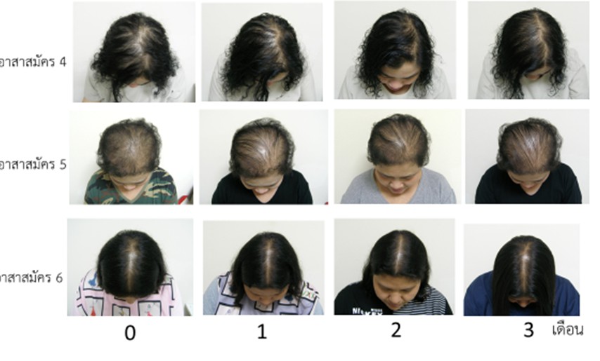 Chula Develops a Proven Formula to Combat Hair Loss and Baldness from Mangrove Trees โ Chulalongkorn University Chula Develops a Proven Formula to Combat Hair Loss and Baldness from Mangrove Trees โ Chulalongkorn University