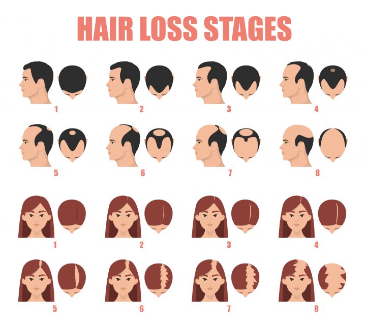 hair loss stages