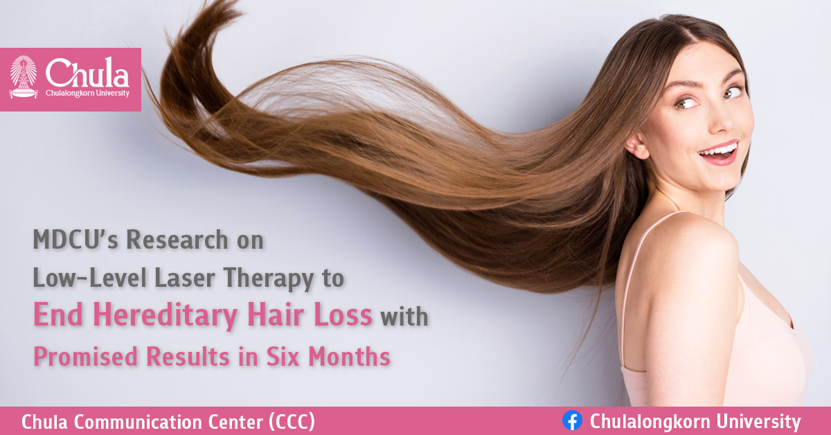 MDCU's Research on Low-Level Laser Therapy to End Hereditary Hair Loss with Promised Results in Six Months – Chulalongkorn University MDCU's Research on Low-Level Laser Therapy to End Hereditary Hair Loss with Promised Results in Six Months – Chulalongkorn University
