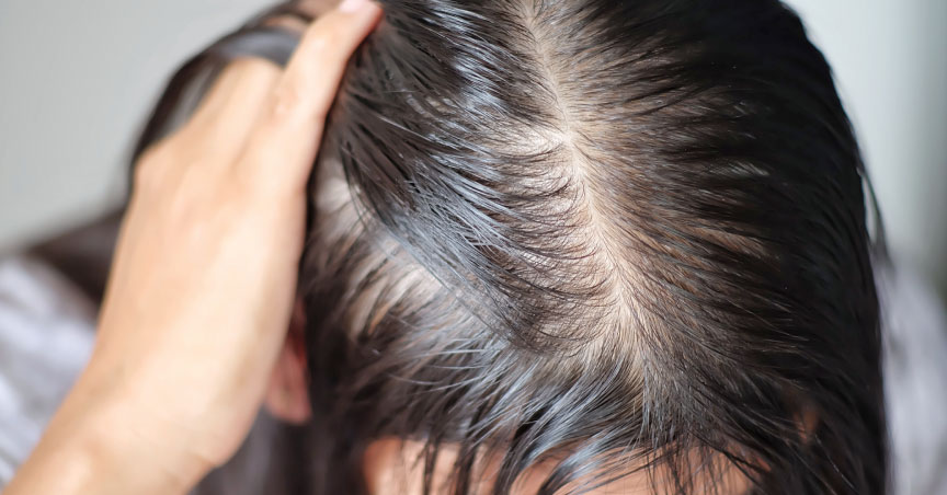 Low-level laser treatment can stimulate hair follicles and hair growth, expert finds