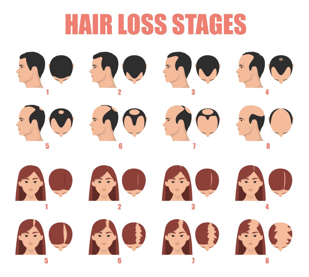 Know More About Pattern Hair Loss In Men  AKS Clinic