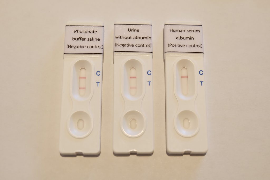 Examples of results on the CKD screening strips