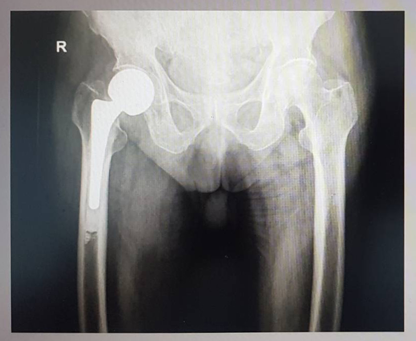 An x-ray image showing the prosthesis hip once it has been attached