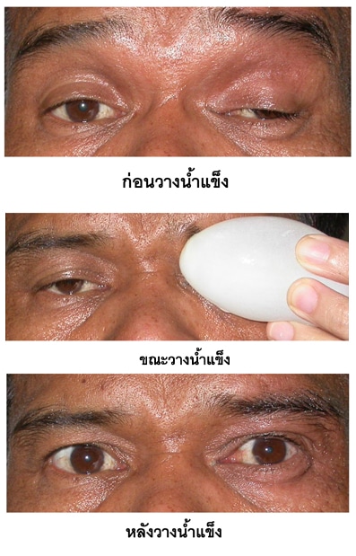 กล้ามเนื้อตาอ่อนแรง ศิริราช