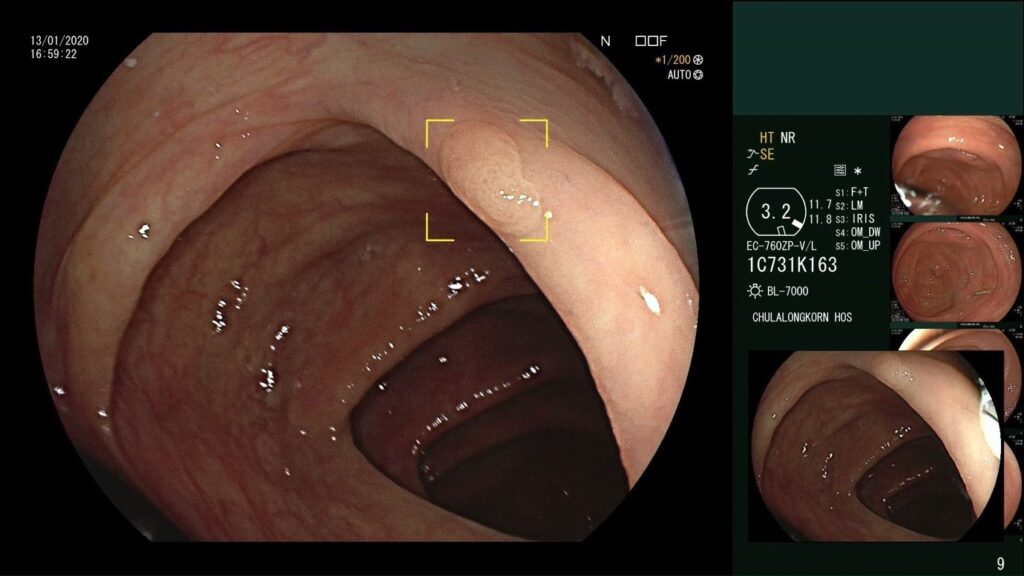 colon polyps detection