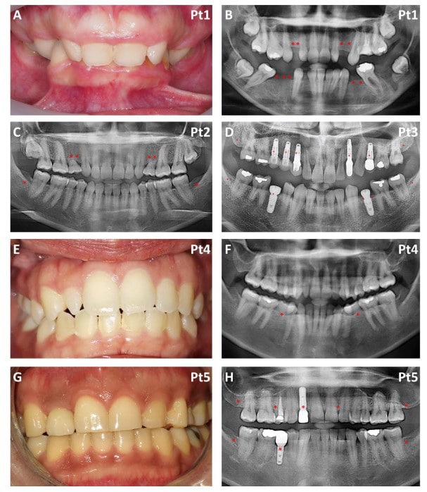 Tooth loss researching process