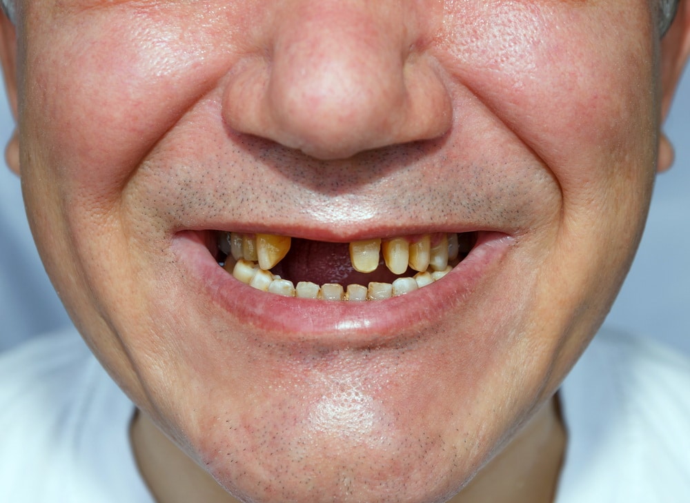 Tooth loss in Thai People