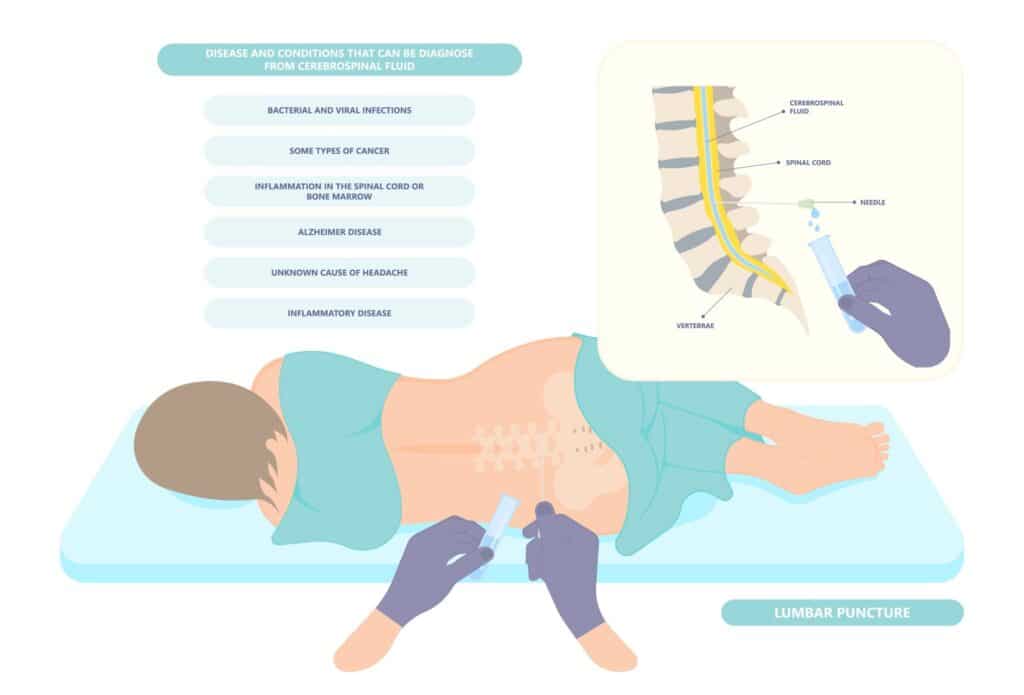 lumbar puncture