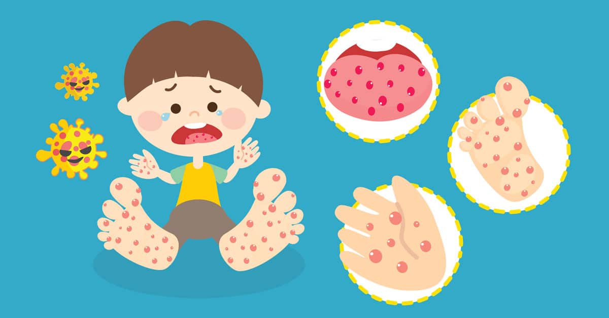 Thailand Must Prepare for More Dangerous EVA71 HFMD Virus, Warns Chula