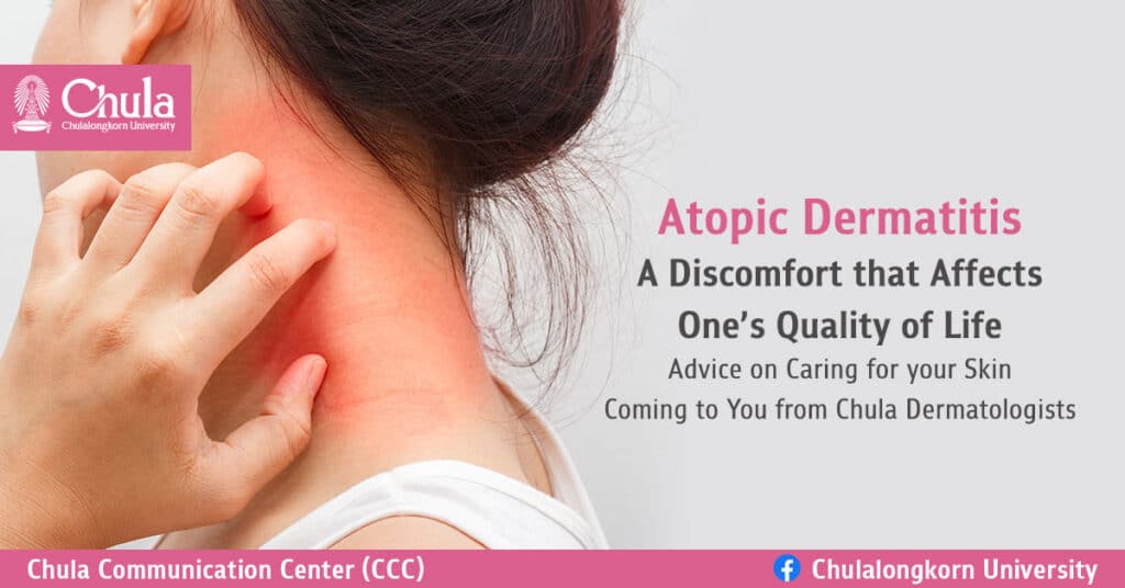 Atopic-Dermatitis