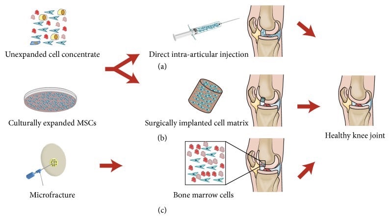 osteoarthritis treatment