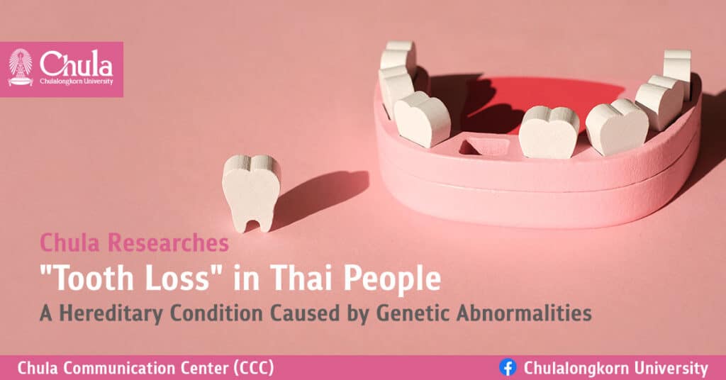 Tooth-Loss-in-Thai-People