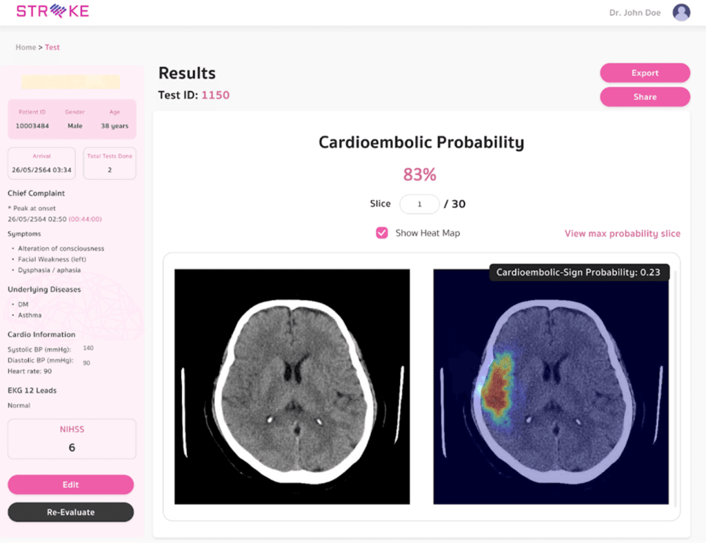 Stroke Analysis Result