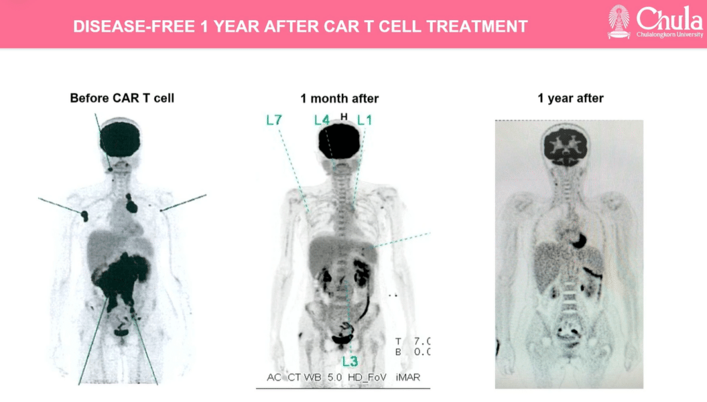 Chula Impact17_CAR-T cell_1YearTreatment