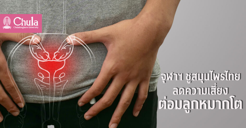 สมุนไพรลดเสี่ยงต่อมลูกหมากโต