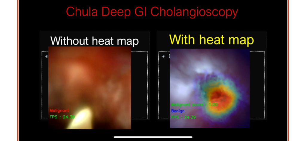 Deep GI Phase 2 การตรวจหามะเร็งในท่อน้ำดี 