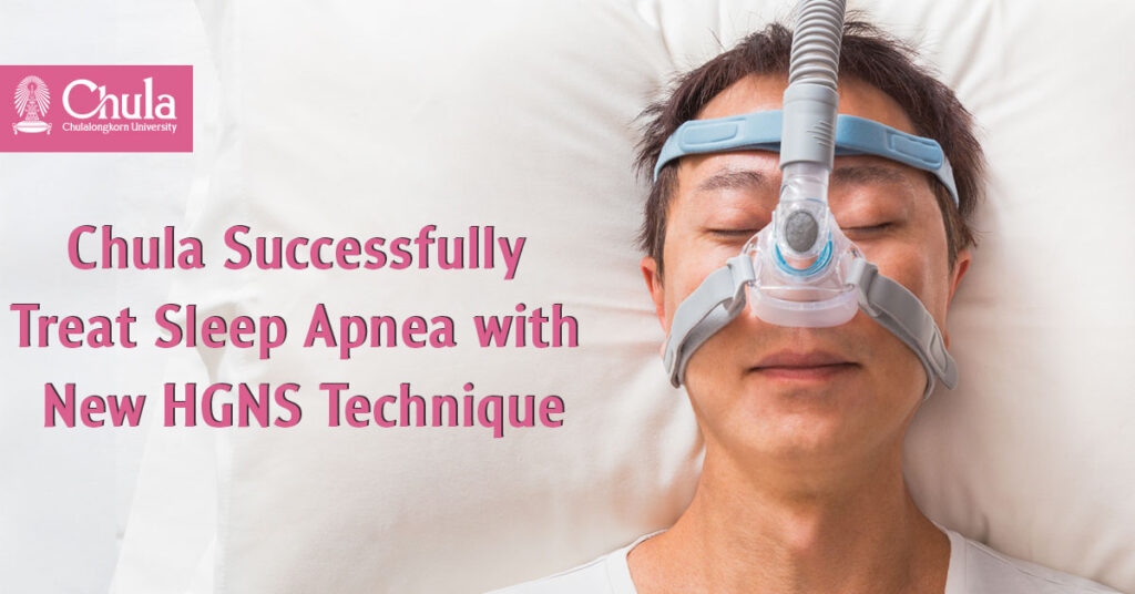 Chulalongkorn University doctors successfully performed surgery for obstructive sleep apnea using the new HGNS technique: the fourth successful surgery of this kind in Asia